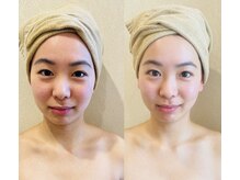 ビオスパ(BioSpa)の雰囲気（高周波WINBACKフェイシャルお顔の引き締まり、鎖骨スッキリ♪）