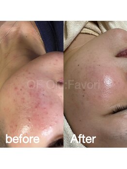 オフオルファヴォリ(OF Olu:Favori)/before after