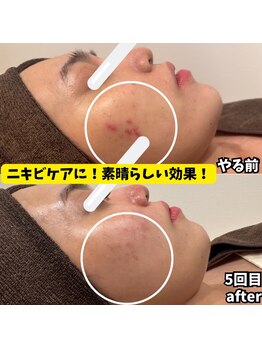 ビアル(VIALU)/短期集中ケアでニキビケア♪