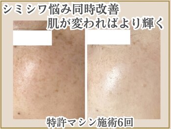 ポモナ 横浜馬車道店(Pomona)の写真/[本気でシミゼロ美肌ケア]個数制限なし!全顔シミケア7980円！たるみやしわも同時にケア！今が一番輝く時★