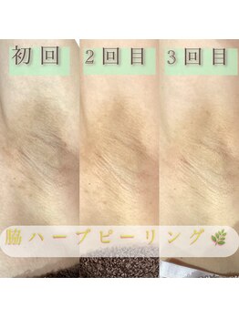 シュエット(Chouette)/ハーブピーリング【脇】