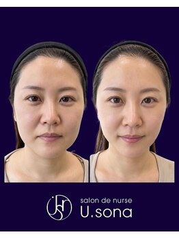 小顔・脂肪コントロール専門 salon de nurse U.sona～松本店～/【顔造形】30代高周波症例