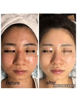 エスカル ボーテ(escale beaute)/赤ら顔・ニキビケア