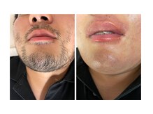 グラティアス(Gratias.)/髭のWAX脱毛施術写真