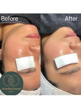 チョンダムビューティー(chondam beauty)/ムルグァン(水光)肌はお任せ～