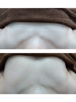 ルアナ(Luana)/BBL光バスト初回→7回施術後