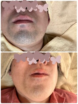 ティアレ 緑井店(Tiare)/W打ち効果