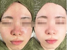 ライム 武庫之荘(LIME)の雰囲気（お肌の悩みに合わせた、丁寧なカウンセリング♪【武庫之荘】）