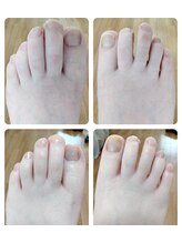 リゼランアンドコー 福島鎌田店(LIZERA&Co)/二枚爪からのbefore/after◎