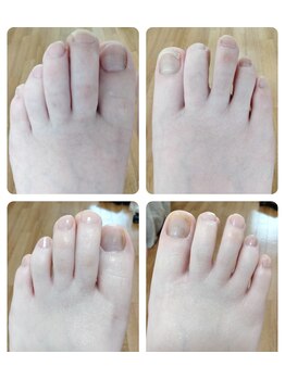 リゼランアンドコー 福島鎌田店(LIZERA&Co)/二枚爪からのbefore/after◎