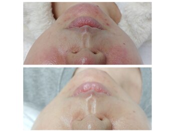 ビーンズ(BEANS)/ララピール