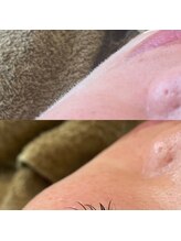 オフモード(OffMode)/脱毛器に反応しない産毛除去