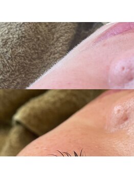 オフモード(OffMode)/脱毛器に反応しない産毛除去