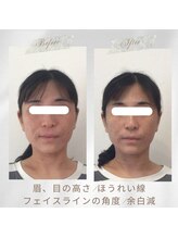 りもあず(ReMore-S)/顔のたるみ/腰痛/首肩のつらさ