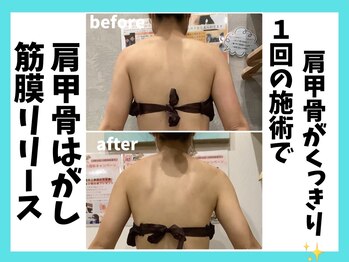 マーブル/筋膜リリース肩甲骨はがし