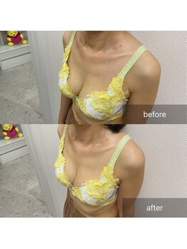 ルミエール(Lumiere)/【倉敷市】バストアップ施術事例