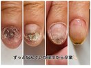 長年悩んでいた爪も綺麗に。
