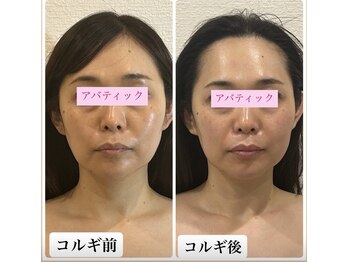 アバティック(ABatick)/小顔矯正コルギ　効果