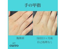 アクト クロ(ACT curro)/【手の甲指】脱毛施術例