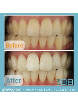 グロウ グロウ(grow.glow)/仙川ホワイトニング