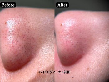 あすはれの写真/ハイドロヴィ-ナス"角質除去・毛穴洗浄"効果にこだわり◎毛穴洗浄でつるつる肌[築地/東銀座/毛穴/毛穴洗浄]