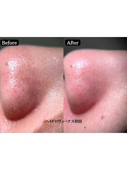 毛穴ケアをしたい