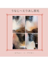 ノノ(nono)/うなじ～えりあし脱毛