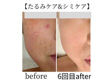 たるみケア+シミケアでリフトアップとシミケアが同時に叶う♪