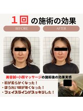 クローバー鍼灸整骨院/美容鍼＋小顔矯正マッサージ