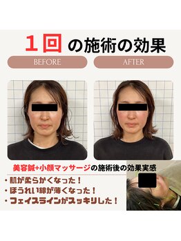 クローバー鍼灸整骨院/美容鍼＋小顔矯正マッサージ