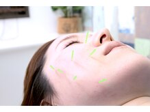 BLBはり灸整骨院 四ツ谷/【美容鍼はり】　四ツ谷