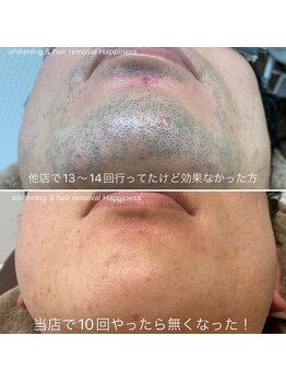 ハピネス 広島並木通り店(Happiness)/ヒゲ脱毛Before→After