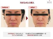 ブリエ/美容皮膚科監修エステ美顔導入器