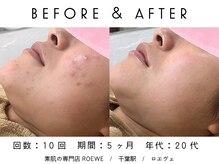 ロエヴェ(ROEWE)/ニキビ改善・毛穴ケア・肌質改善