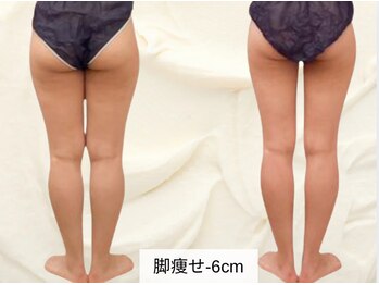 トレゾール(tresor)/【痩身】セルライト撃退（-６cm)