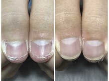 ブルームーンネイルズ(BLOOMOON.nails)/当日見た目改善！