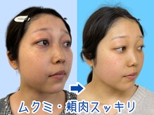 ナチュラルパーフェクトフェイス 新宿/一回で変わる新宿小顔矯正専門店