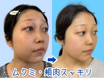 ナチュラルパーフェクトフェイス 新宿/一回で変わる新宿小顔矯正専門店