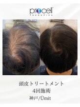 ユミト(Umit)/プロセルスカルプ