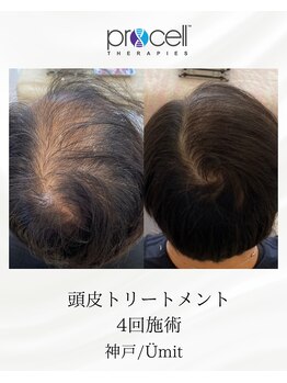 ユミト(Umit)/プロセルスカルプ