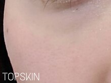 トップスキン 新宿(TOPSKIN)/ハーブピーリングで肌育ケア◎