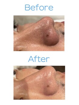 シャイニー(SHINY)/ハイドラ毛穴洗浄