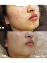 ビーピー 渋谷(b.p.)/ニキビケア　ハーブピーリング