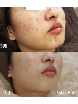 ビーピー 渋谷(b.p.)/ニキビケア ハーブピーリング