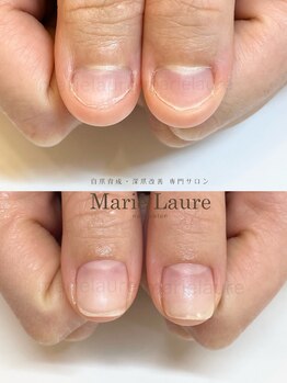 マリーロール 梅田店(Marie Laure)/深爪矯正/自爪育成/ネイルケア