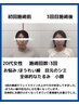 小顔しわシミ改善美容鍼 初回60分¥6500→￥3500