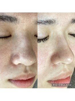 ルリアン(Le Lien)/いちご鼻撃退!