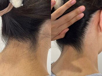 シロ(Shiro)/MIX脱毛うなじデザイン