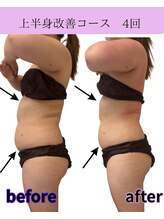 リラ(Lilas)/【痩身】たるみ改善上半身　4回