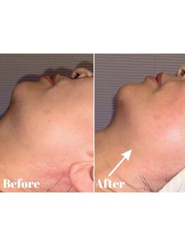 小顔になりたい